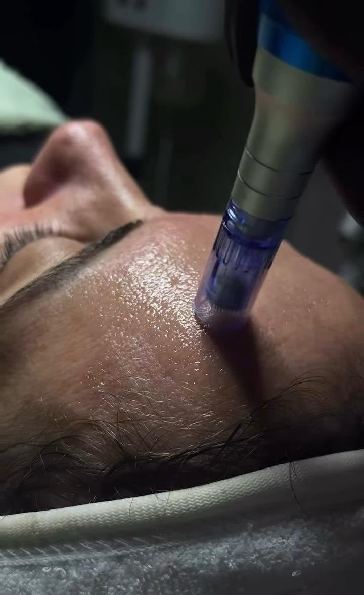 Tratamiento facial Dermapen