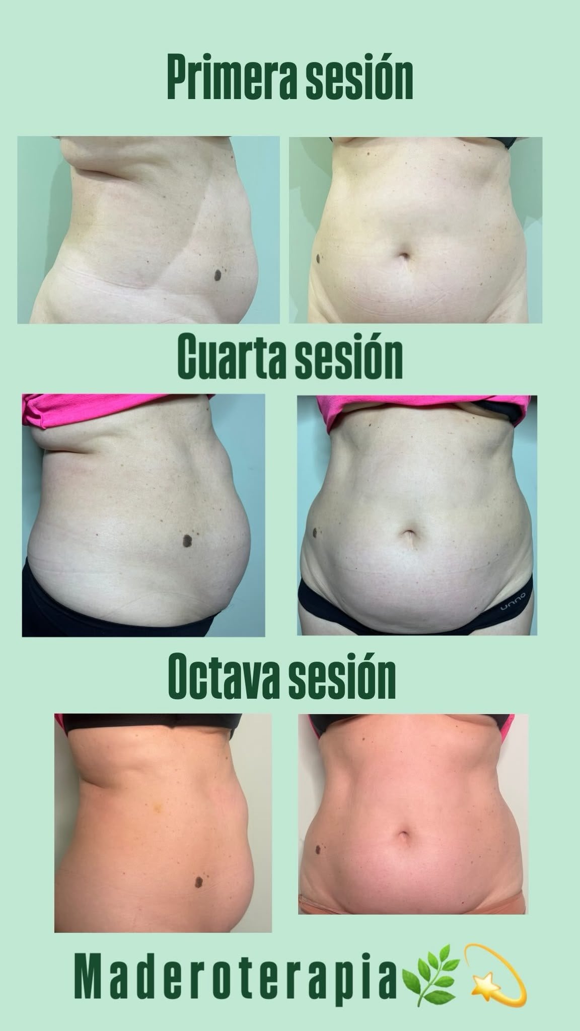 Progresión de maderoterapia tras varias sesiones